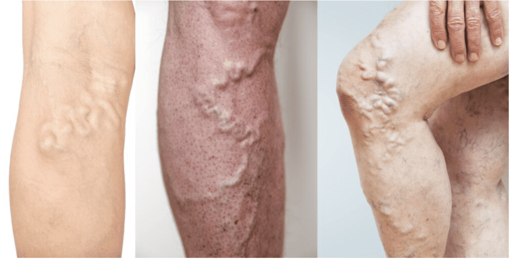 Deep Vein Thrombosis