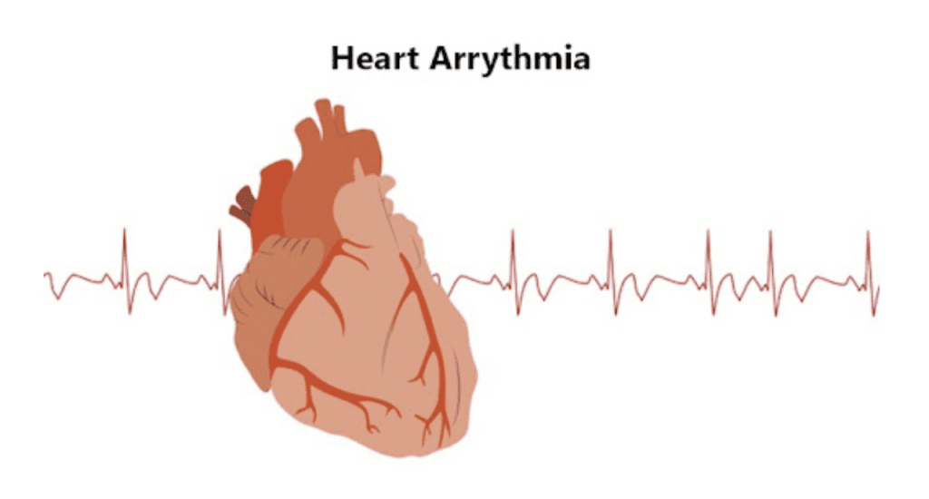 Heart Arrythmia