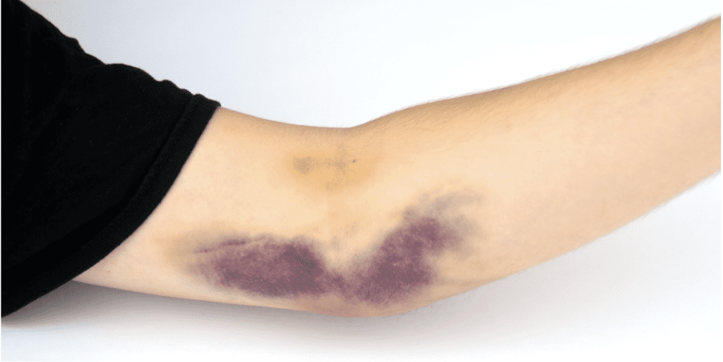 Hematoma