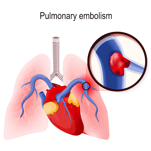 pulmonary embolism